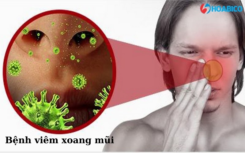 Những nguyên nhân gây bệnh viêm xoang mũi